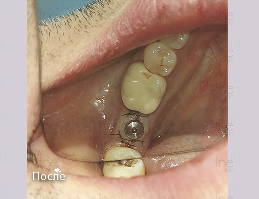 Одномоментная имплантация зубов в клинике Селин