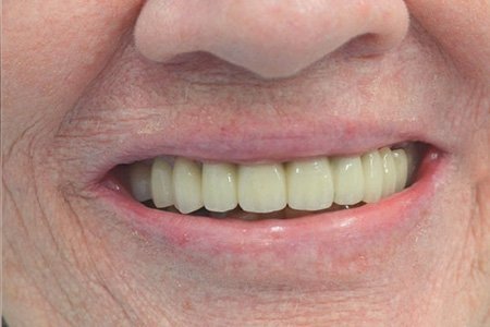 Костная регенерация зубов