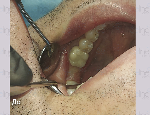 После имплантации зубов
