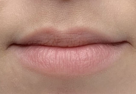 Исправление асимметрии контура губ