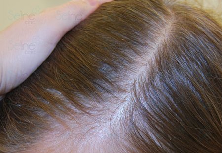 Пептидная стимулирующая терапия для волос