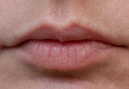 Результат процедуры пластики губ