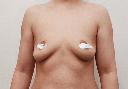 Коррекция формы груди