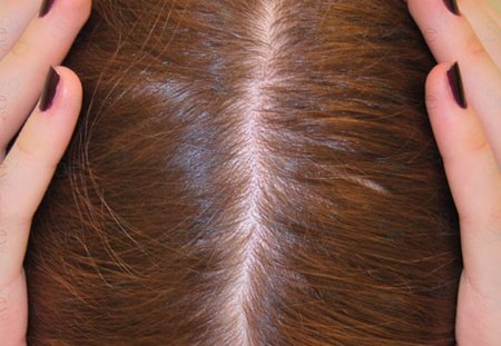 Лечение волос у трихолога
