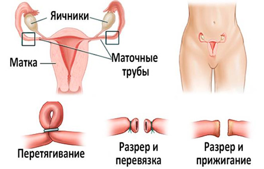 Операции в анамнезе могут привести к внематочной беременности
