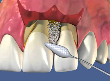 Лоскутная операция на десне - стоматологическая хирургия