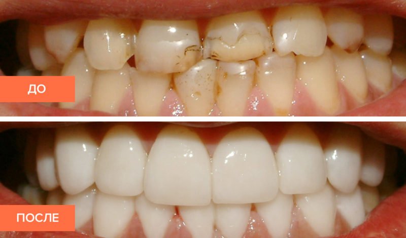 зубы до и после реставрации керамическими винирами 