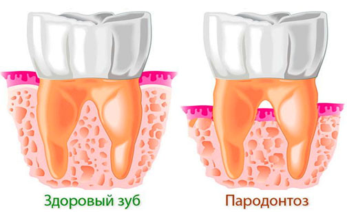 Сравнение здорового зуба с зубом пораженным пародонтозом