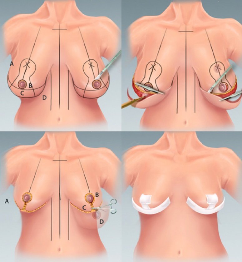 схема техники проведении уменьшения груди