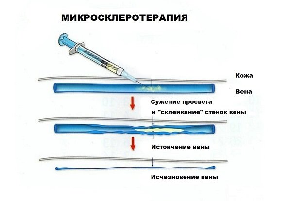 схема проведения микросклеротерапии