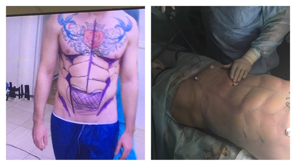 фото: до и после липоскульптурирования