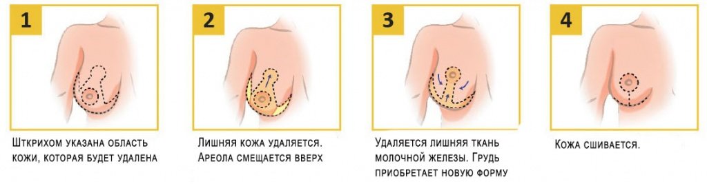 этапы проведения якорной подтяжки груди