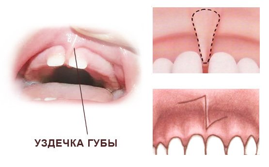 шов после пластики уздечки губы для удаления щели между передними резцами