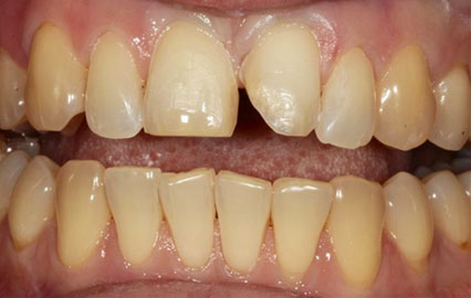 Что способствует ускоренной стираемости зубов?