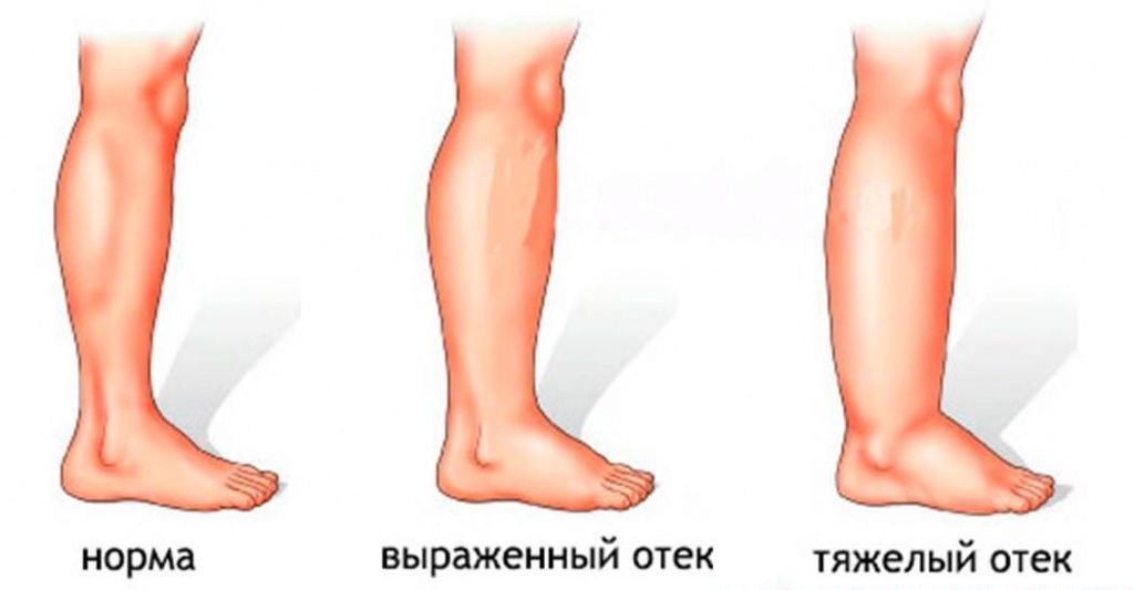 фото нормальной ноги, выраженного отёка и тяжёлого отёка
