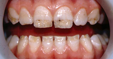 Фото гипоплазии зубов