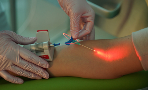 Процедура внутривенного лазерного облучения крови