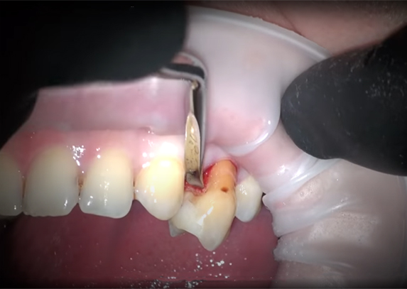 Процесс удаления зуба в клинике Seline в Москве