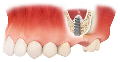 Преимущества расширения альвеолярного гребня: стоматология Seline