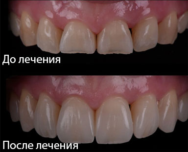 Фото до/после лечения паталогической стираемости зубов