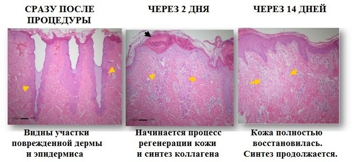 схема восстановления кожи после РФ-лифтинга лица