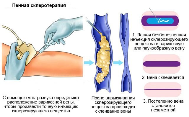схема проведения процедуры пенной склеротерапии