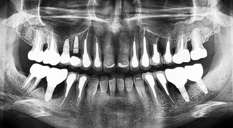 3-D снимок зубов для диагностики пародонтита