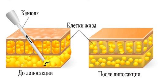 клетки жира до и после проведения липосакции боков и спины