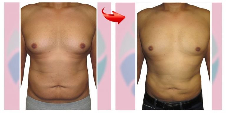 липосакция груди у мужчин до и после