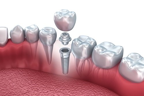установка импланта зуба по одномоментной системе