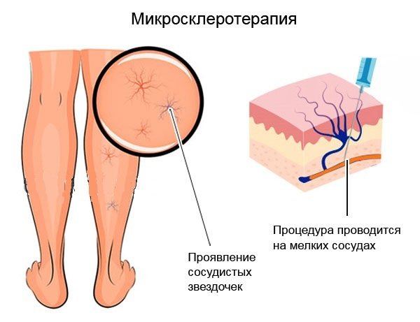 схема проведения микросклеротерапии нижних конечностей