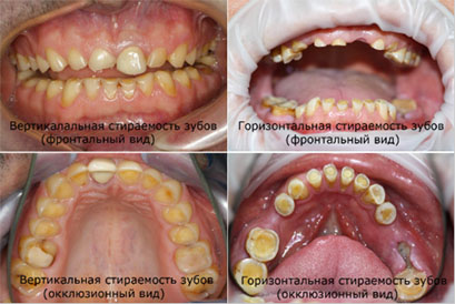 классификация аатологической стираемости зубов