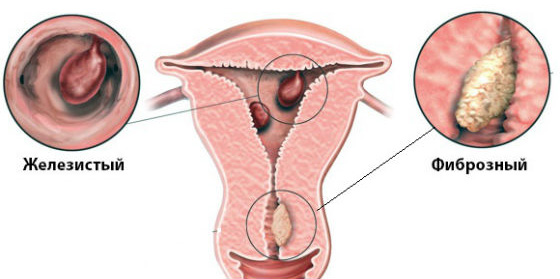Виды полипов эндометрия