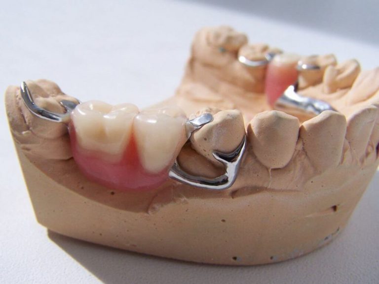 фото протезирования нижнего ряда зубов бюгельными протезами