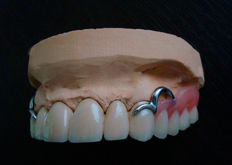 фото бюгельного протеза на кламмерах на верхнем ряде зубов