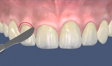 проведение стоматологической операции гингивэктомия