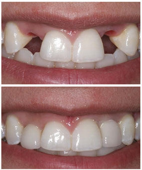Остеопластика в стоматологической клинике Seline
