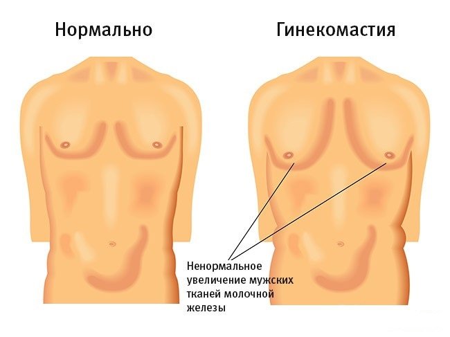 ненормальное увеличение мужских тканей молочной железы