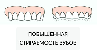 Схема патологической стираемости зубов