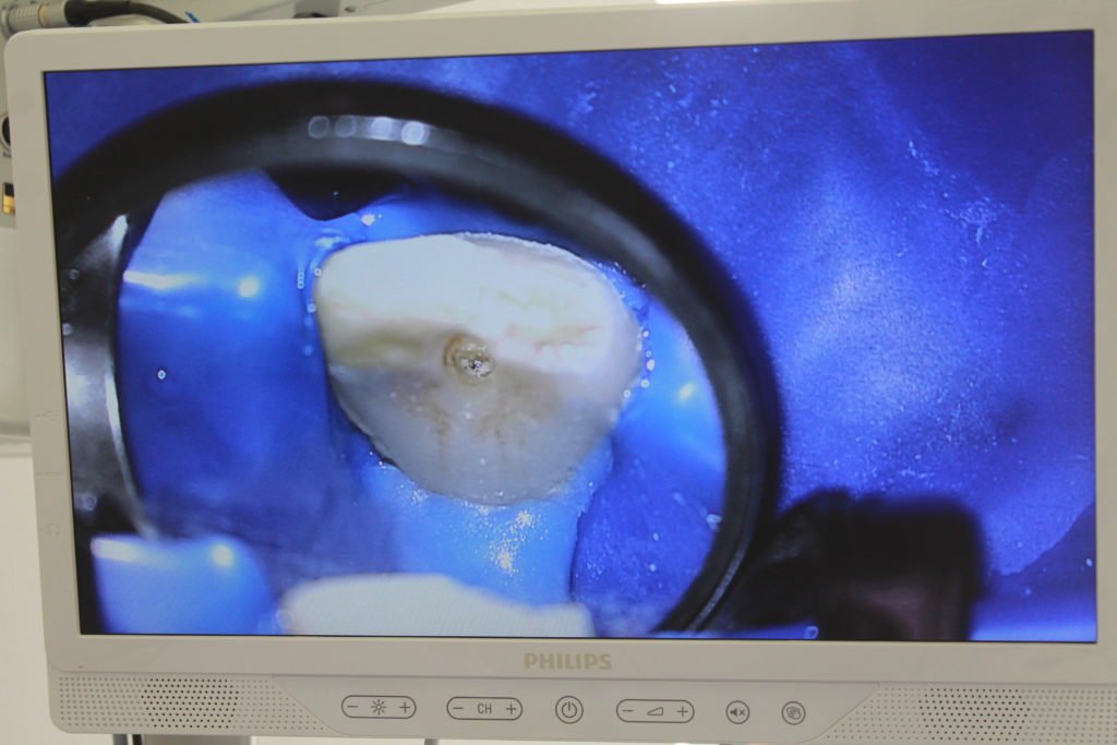 увеличенное изображение высокого качества с помощью стоматологического микроскопа
