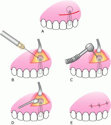 техника проведения операции цистэктомия зуба