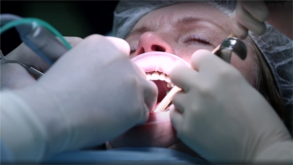 Удаление зубов под общим наркозом в Seline