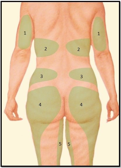 точки проведения липосакции тела