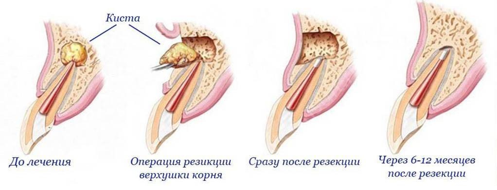 этапы проведения стоматологической операции удаления кисты