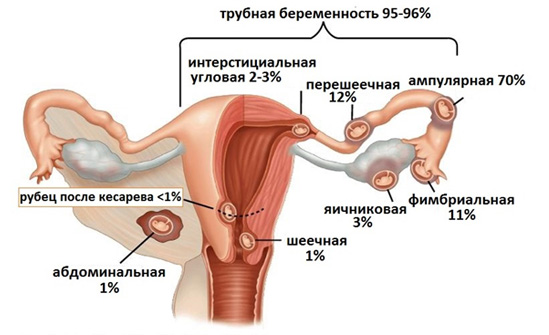 Где может развиваться внематочная беременность