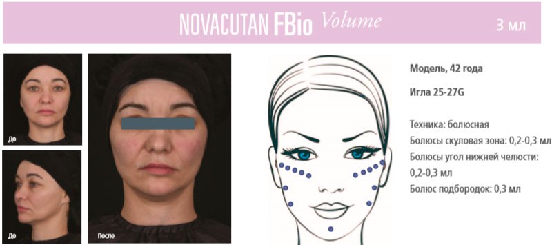 фото: до и после филлеров Novacutan Volume