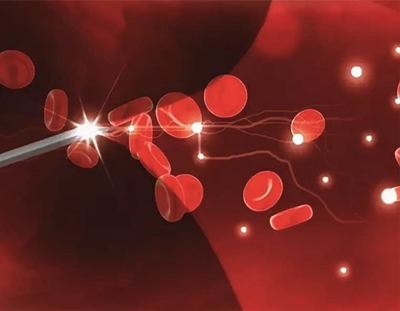 Схема внутривенного лазерного облучения крови