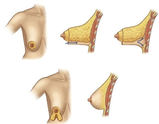 Способы коррекции тубулярной груди