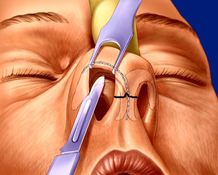 техника проведения операции по септопластике носовой перегородки
