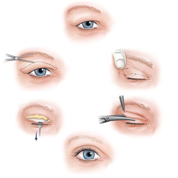 техника проведения операции по европеизации глаз
